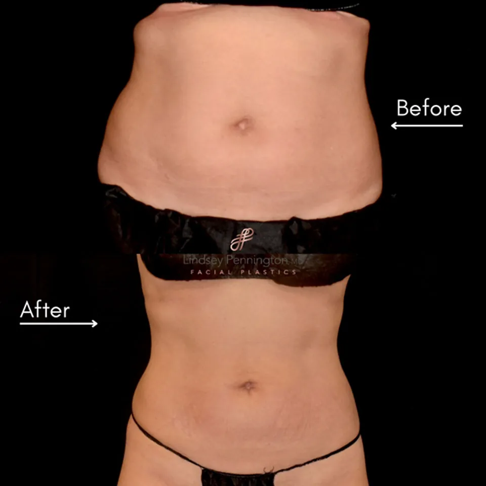 Coolsculpting before and after photo