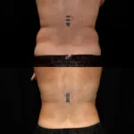 Coolsculpting before and after photo