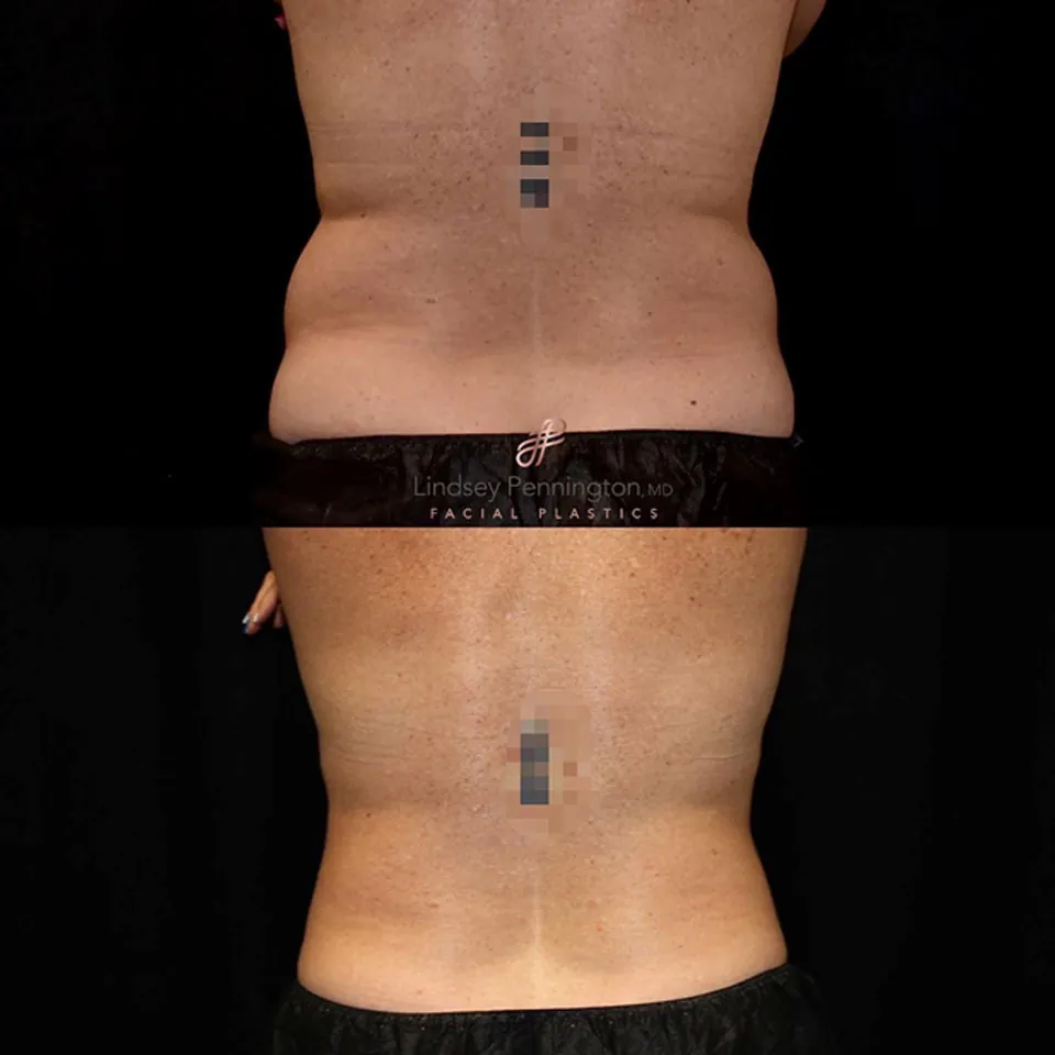 Coolsculpting before and after photo