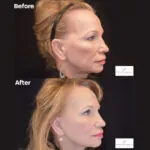 Facelift before and after photo