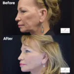 Facelift before and after photo