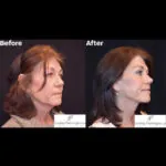 Facelift before and after photo