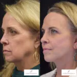 Facelift before and after photo