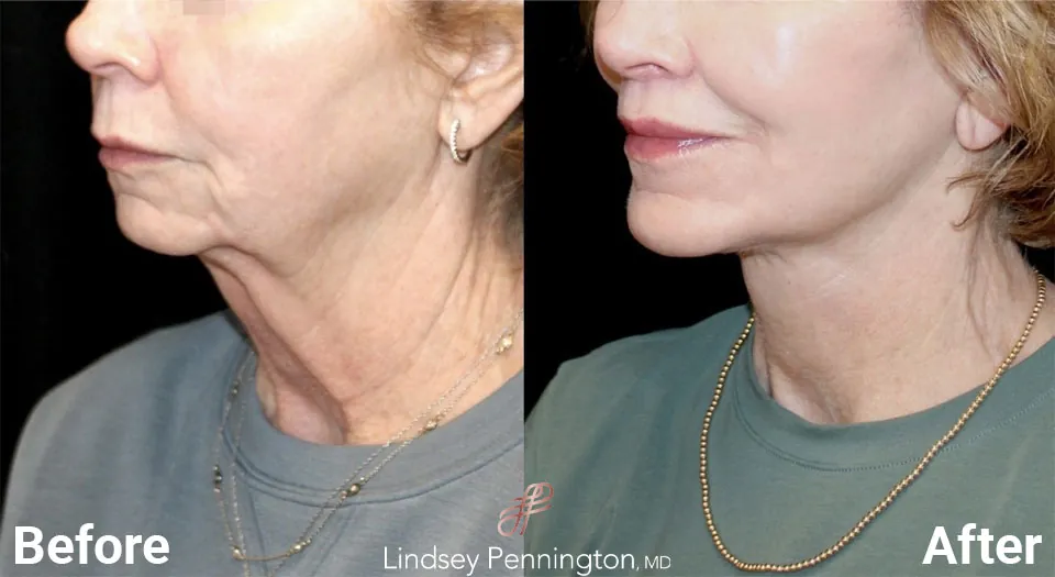 Facelift before and after photo