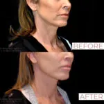 Facelift before and after photo