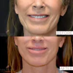 Facelift before and after photo