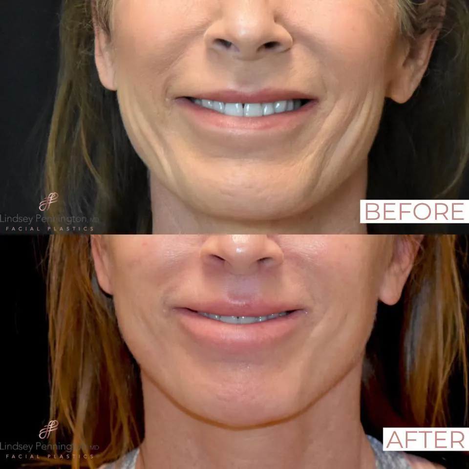 Facelift before and after photo