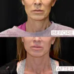 Facelift before and after photo