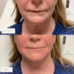 Dermal Filler before and after photo