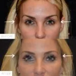 Dermal Filler before and after photo