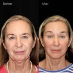 Facelift before and after photo