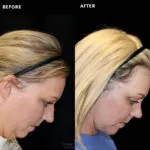 Facelift before and after photo