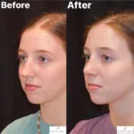 Rhinoplasty before and after photo