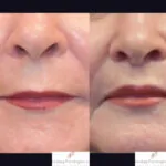 Lip Lift before and after photo