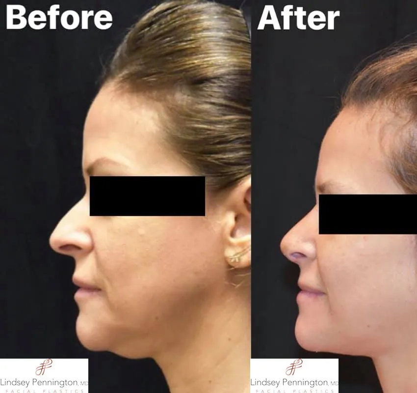 Liposuction before and after photo