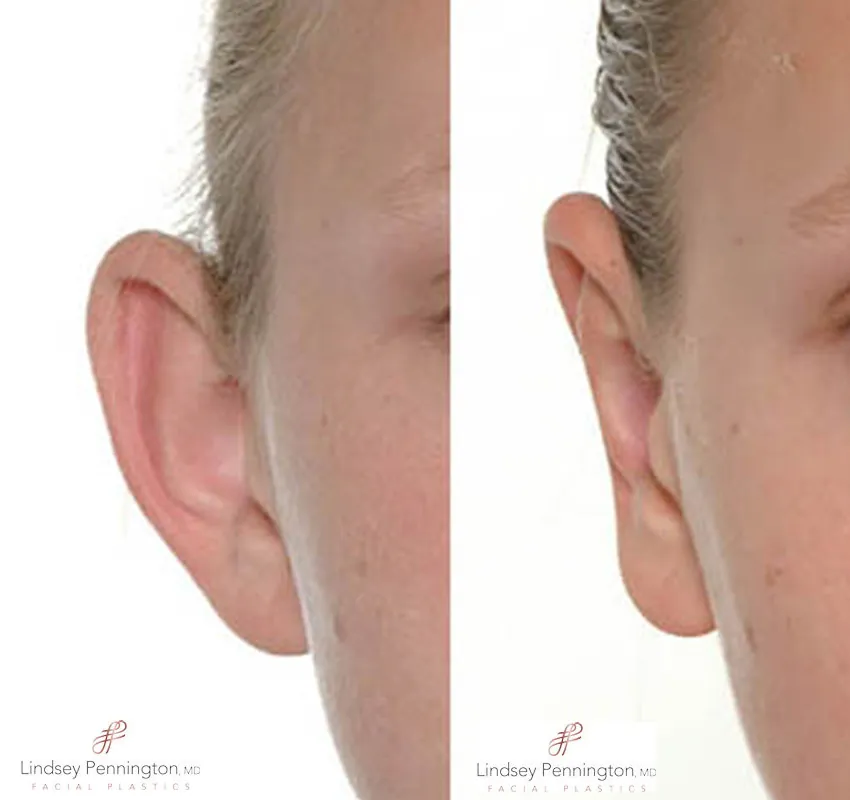 otoplasty before and after