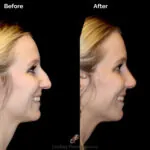 Rhinoplasty before and after photo