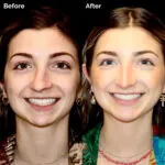 Rhinoplasty before and after photo