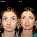 Rhinoplasty before and after photo