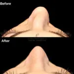 Rhinoplasty before and after photo