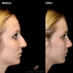 Rhinoplasty before and after photo