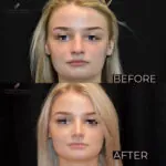 Rhinoplasty before and after photo