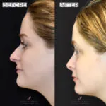 Rhinoplasty before and after photo