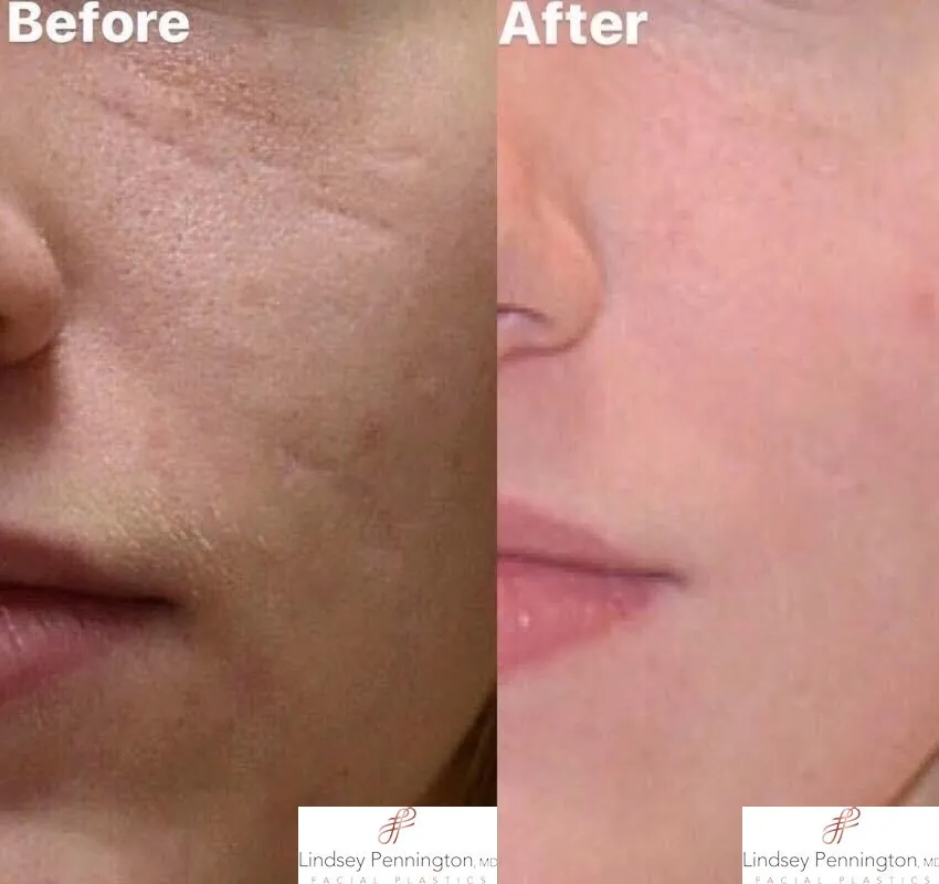 Scar revision before and after photo