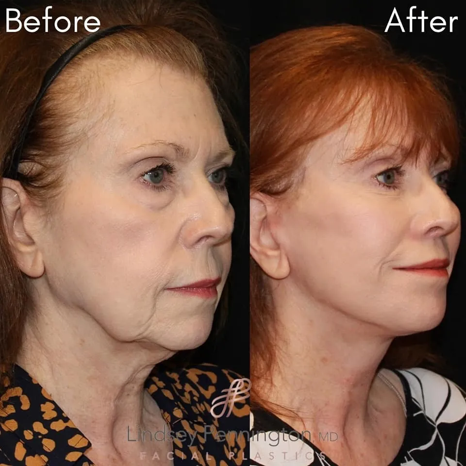 Facelift before and after photo