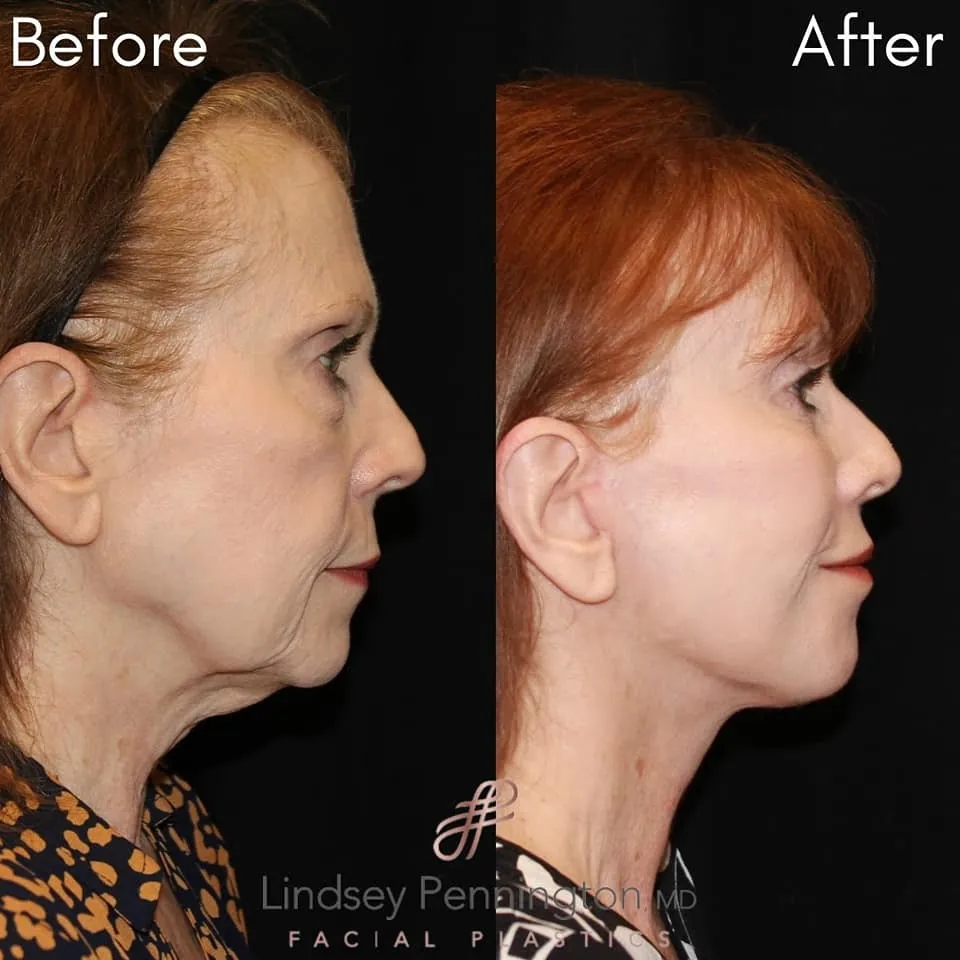 Facelift before and after photo