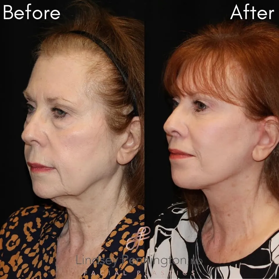 Facelift before and after photo