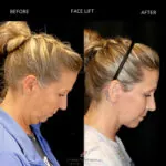 Facelift before and after photo