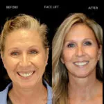Facelift before and after photo