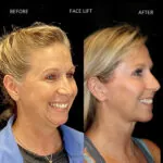 Facelift before and after photo