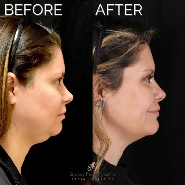 FaceTite before and after photo