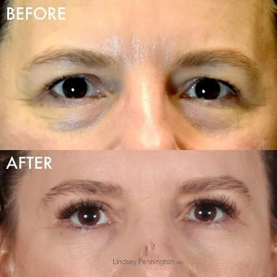 Blepharoplasty before and after photo