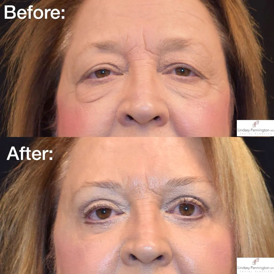 Blepharoplasty before and after photo