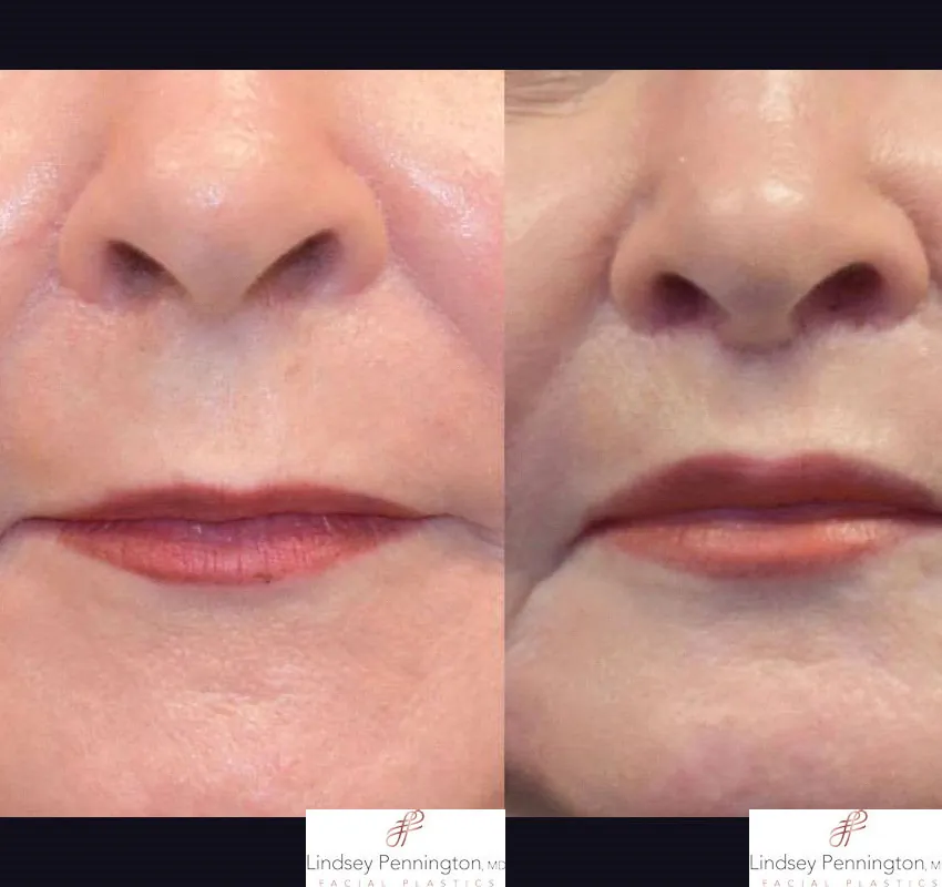 Before and after comparison of a lip lift procedure