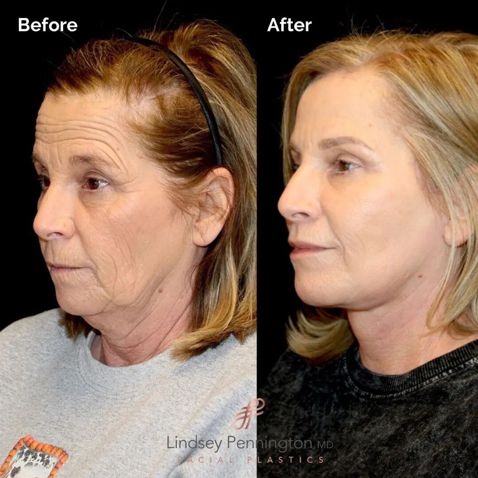 Necklift before and after