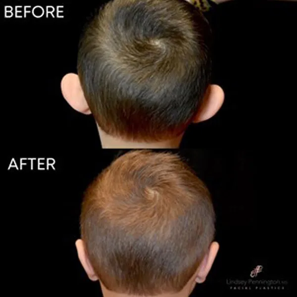 otoplasty before and after