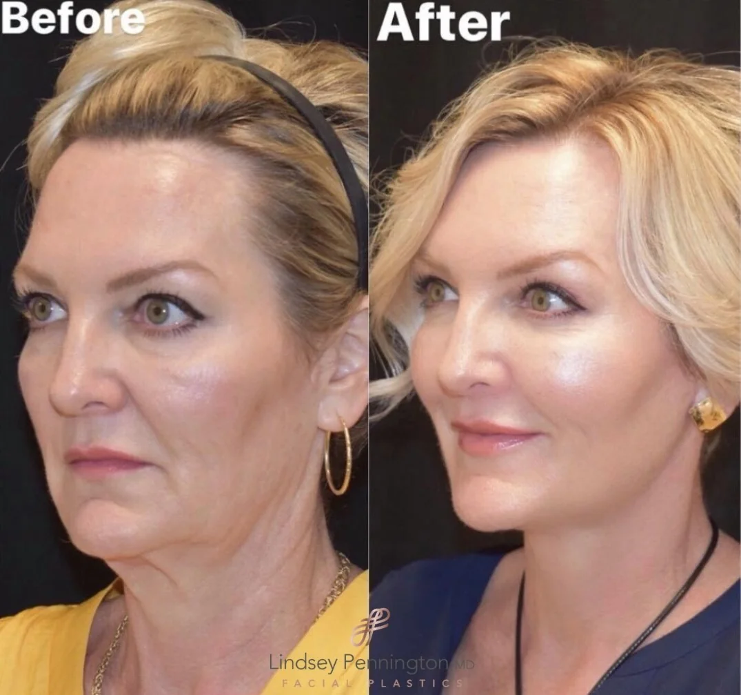 Facelift before and after photo