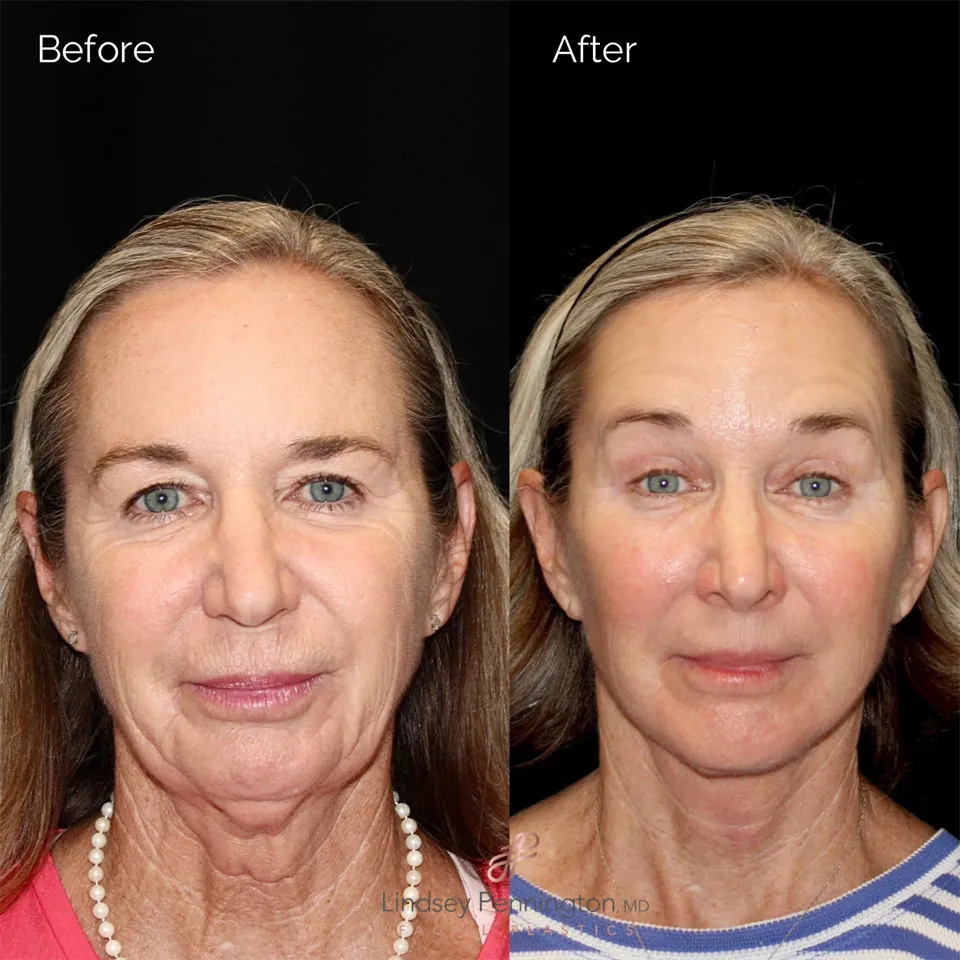 Facelift before and after photo