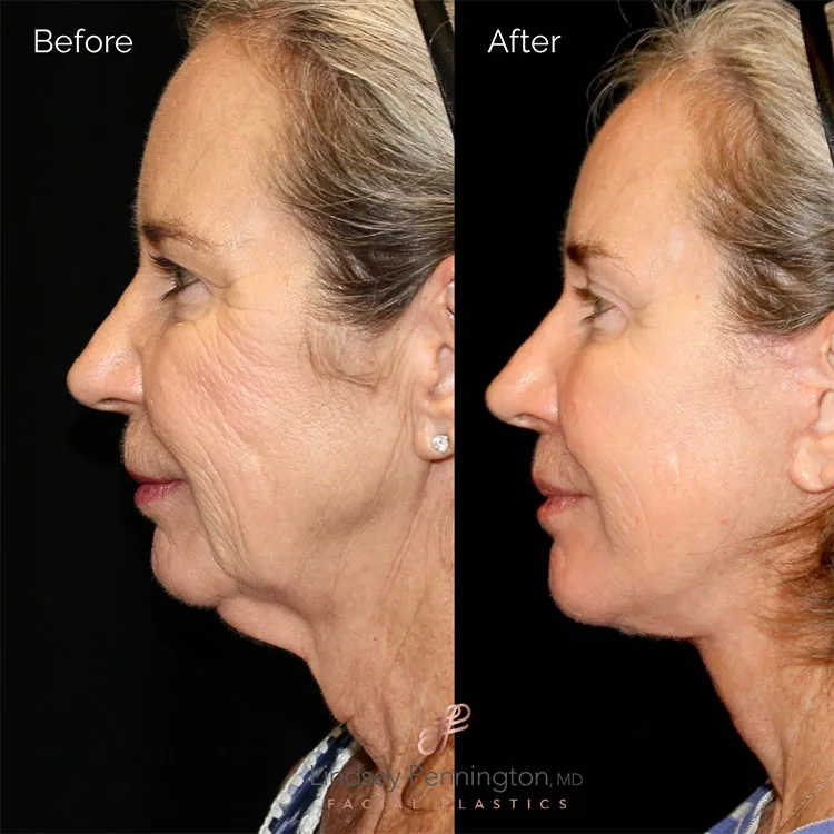 Facelift before and after photo