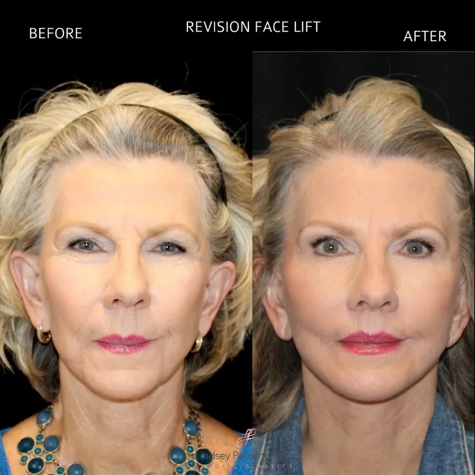 Facelift before and after photo