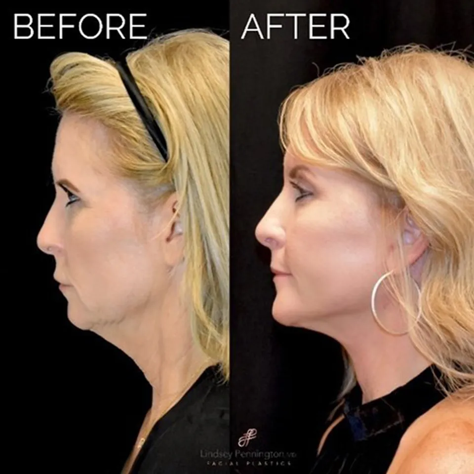 Facelift before and after photo