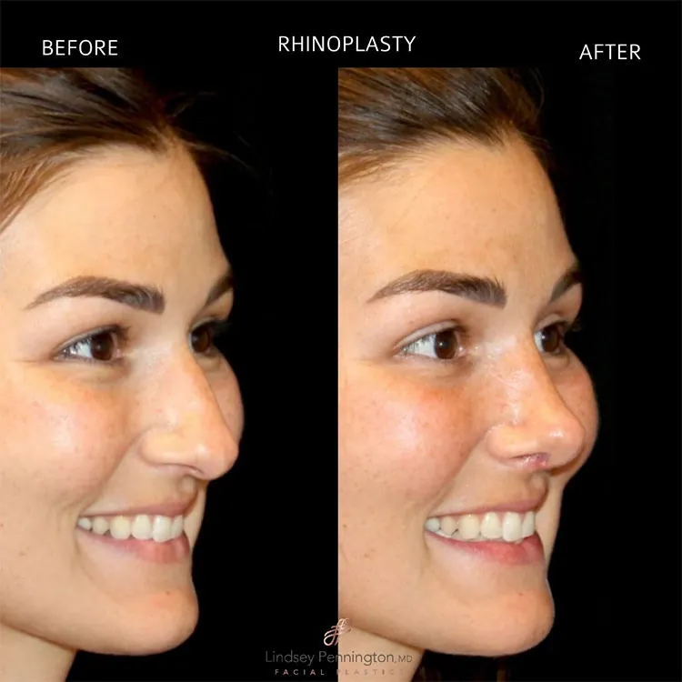 Rhinoplasty before and after photo