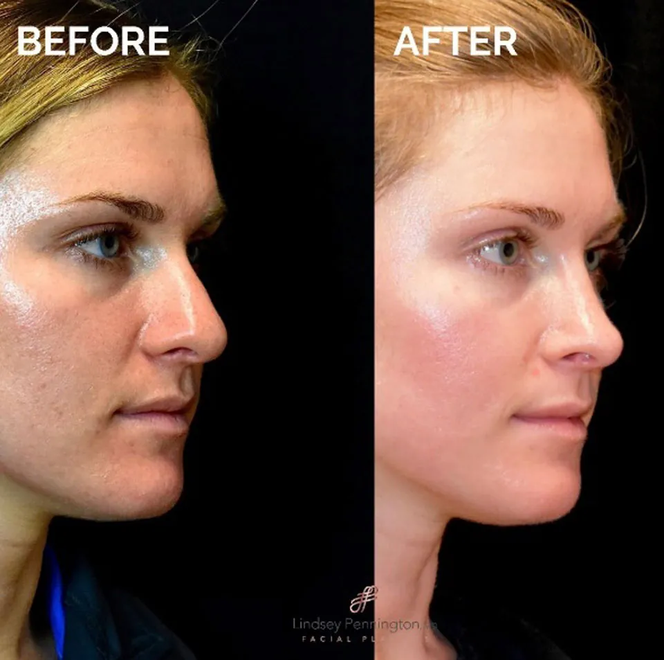 Rhinoplasty before and after photo