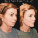 Facelift patient three quarter view right